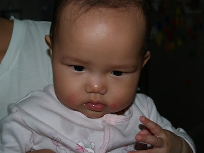 Zaria's rashes clearing