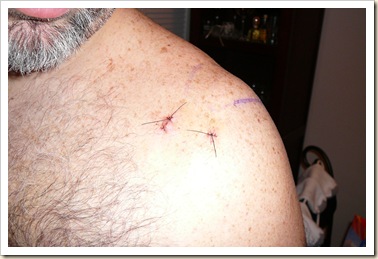 Front Incisions