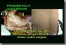 luka-bakar-1
