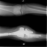 http://lh5.google.com/technologiclee/Rfc5m_Wn87E/AAAAAAAAAHQ/ya9uhANLMDU/s160-c/ProstheticImplantXRays.jpg